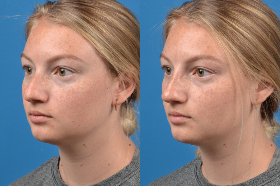 Liquid Rhinoplasty Photos Melbourne Fl Patient